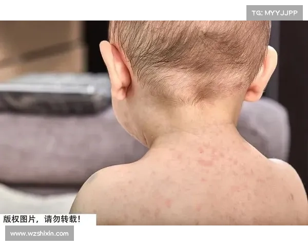 早期天花的预防与治疗方法 早期天花的预防与治疗方法